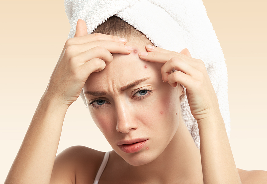 How to Get Rid of Forehead Acne Naturally?